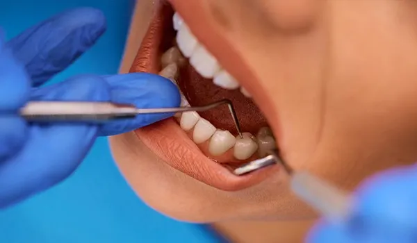 Detartrage des dents