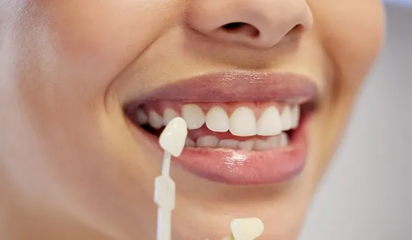 Blanchiment Dentaire